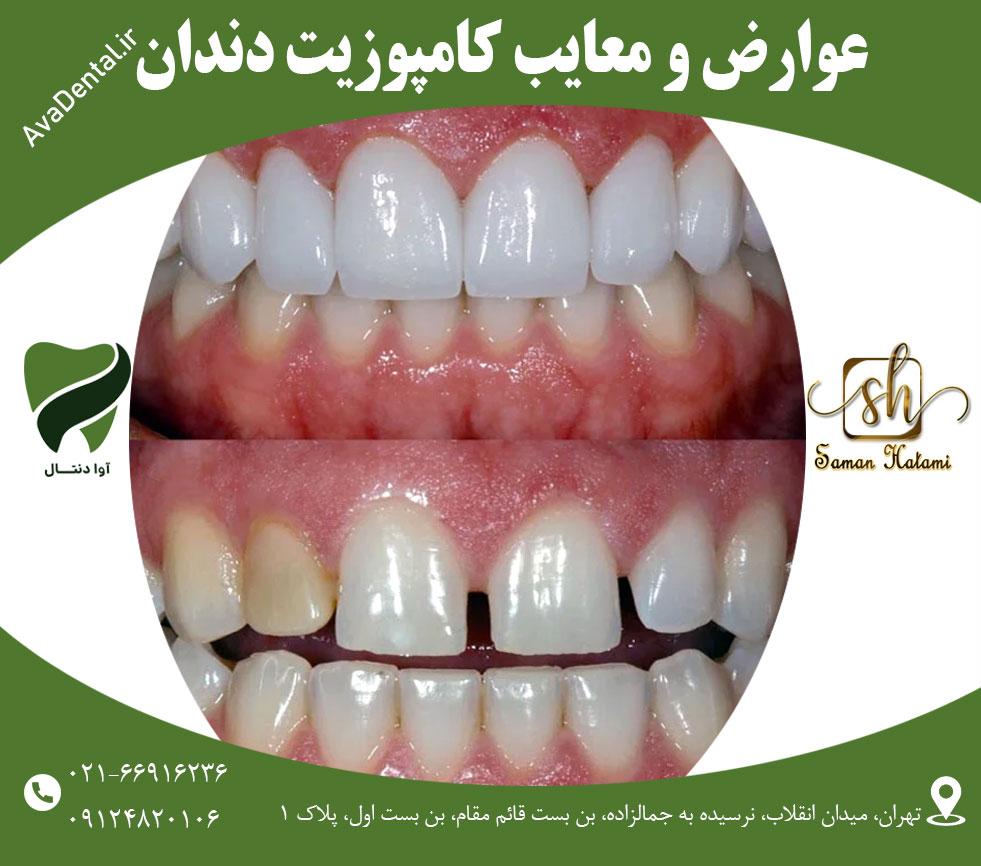 کامپوزیت دندان معایب و عوارض آن | آوادنتال