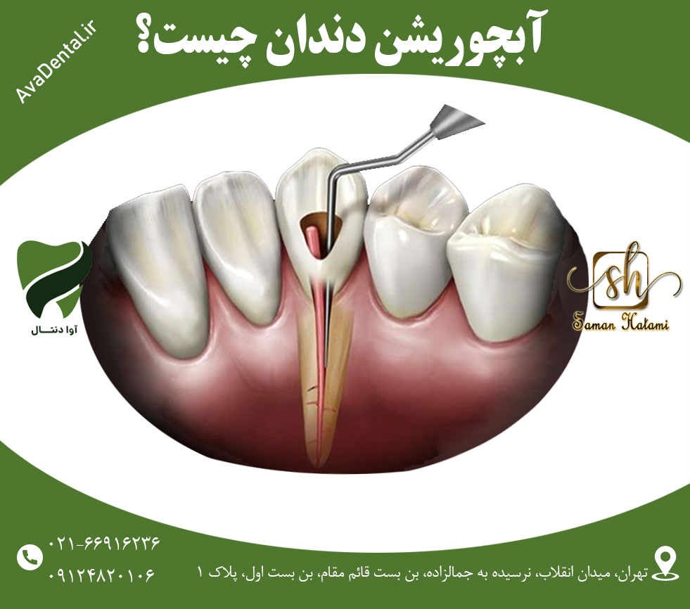 آبچوریشن دندان چیست؟ | آوادنتال