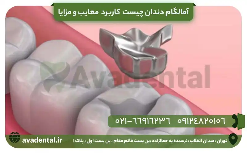 آمالگام دندان چیست؟ کاربرد + معایب و مزایا