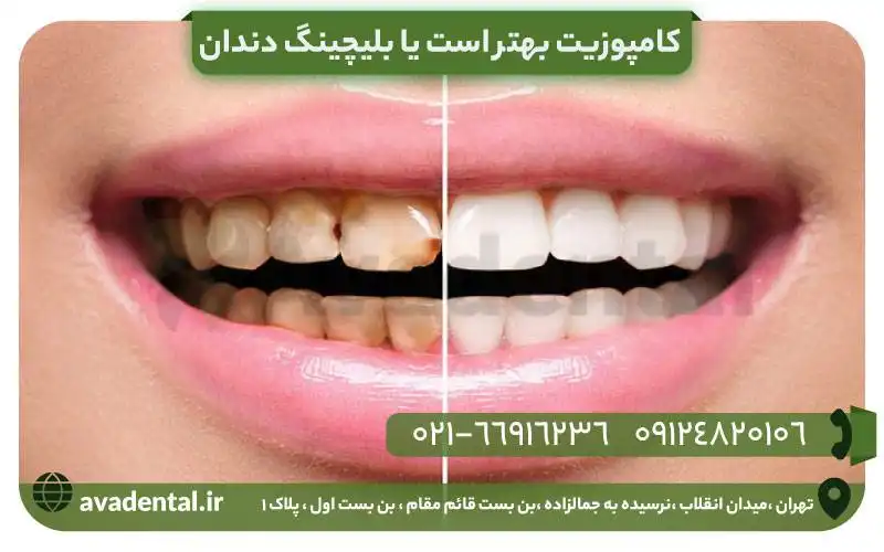 کامپوزیت بهتر است یا بلیچینگ دندان؟ | تفاوت ها، معایب، مقایسه قیمت