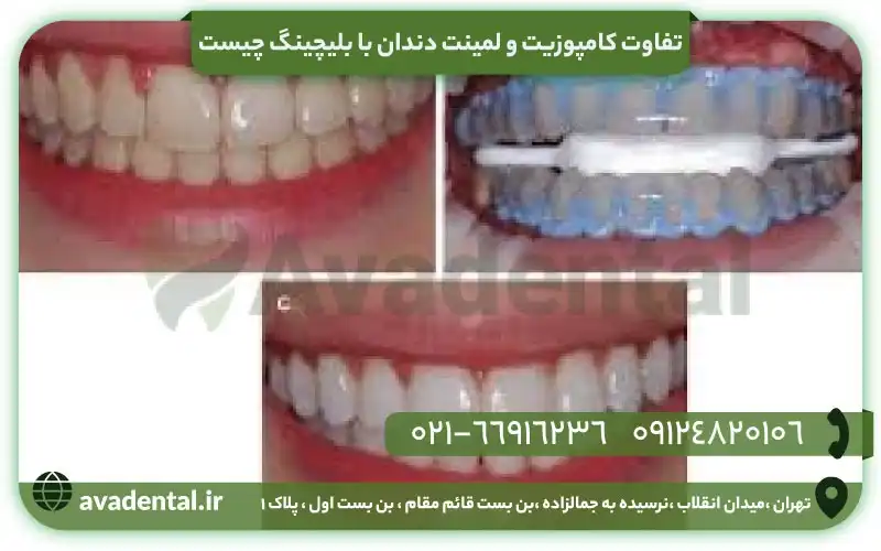 تفاوت کامپوزیت و لمینت دندان با بلیچینگ چیست؟