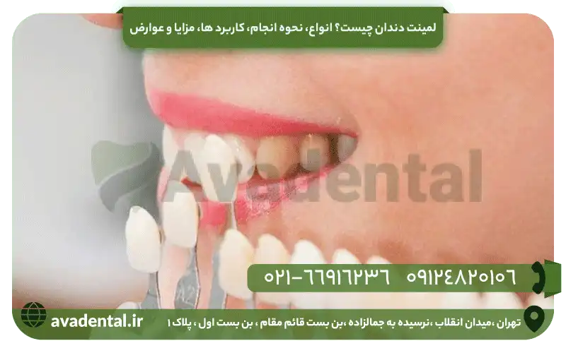 لمینت دندان چیست؟ انواع، نحوه انجام، کاربرد ها، مزایا و عوارض