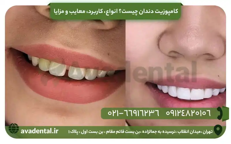 کامپوزیت دندان چیست؟ انواع، کاربرد، معایب و مزایا