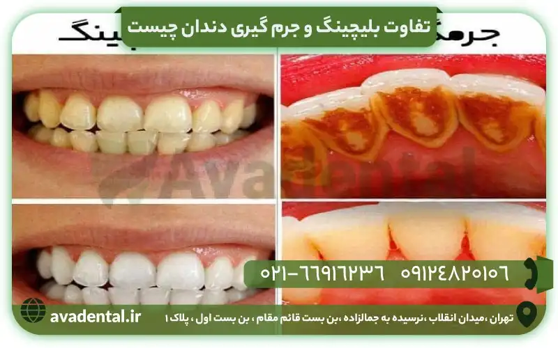 تفاوت بلیچینگ و جرم گیری دندان چیست؟