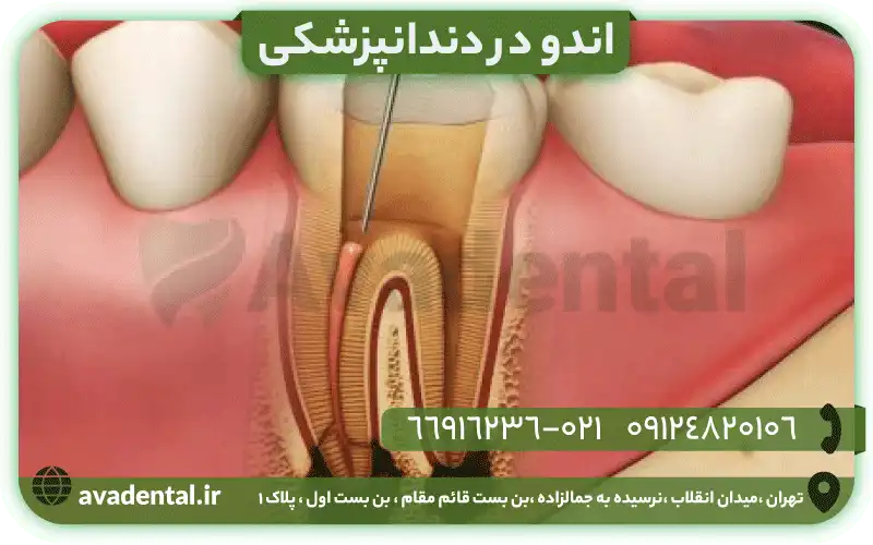 اندو چیست؟