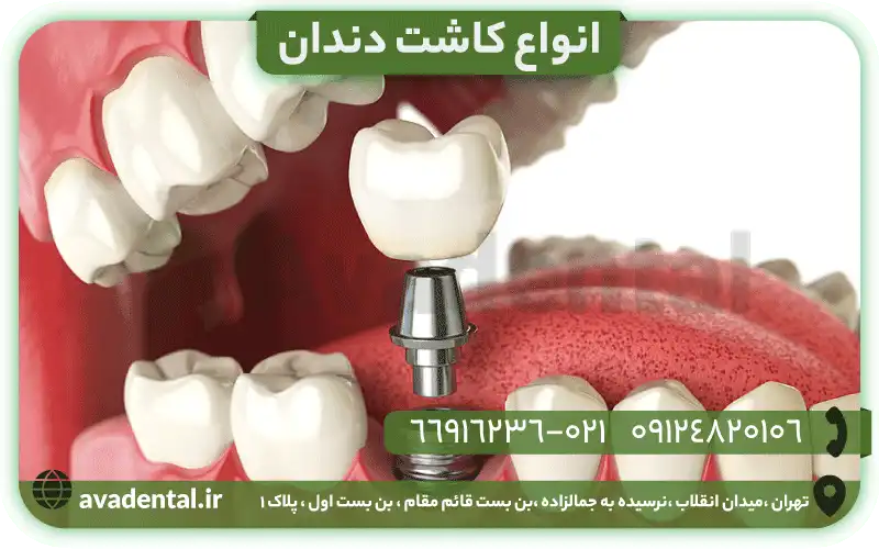 انواع کاشت دندان