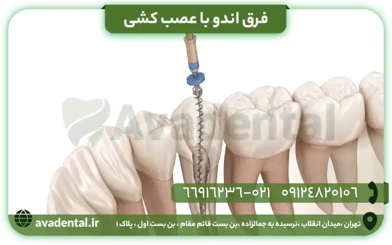 فرق اندو با عصب کشی