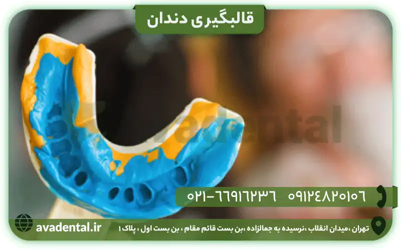 قالبگیری دندان
