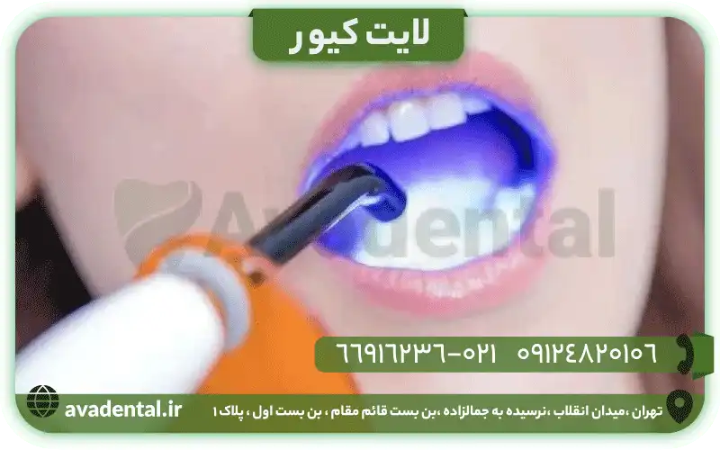 لایت کیور دندانپزشکی چیست