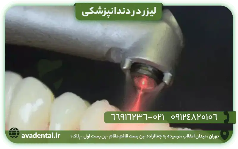 لیزر در دندانپزشکی