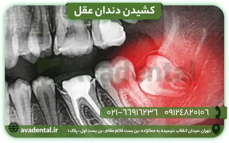 کشیدن دندان عقل