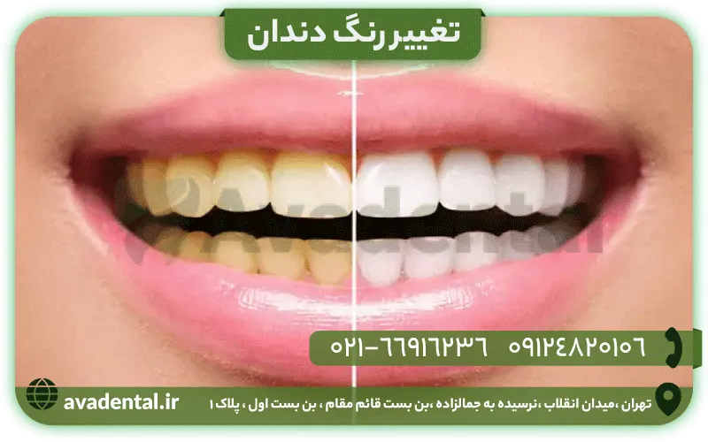 تغییر رنگ دندان