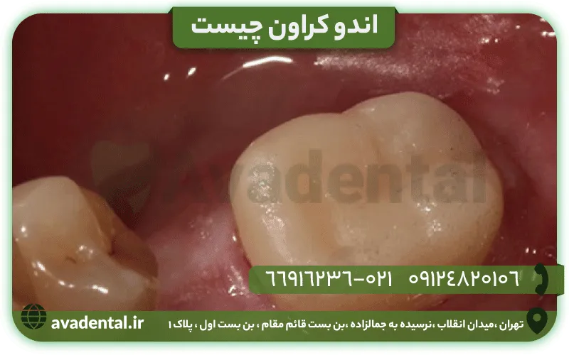 اندو کراون چیست
