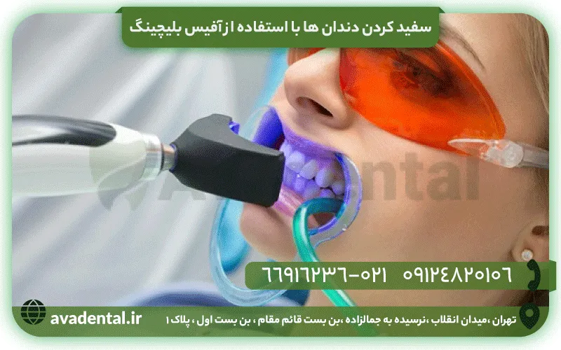 سفید کردن دندان ها با استفاده از آفیس بلیچینگ 13 سفید کردن دندان ها با استفاده از آفیس بلیچینگ