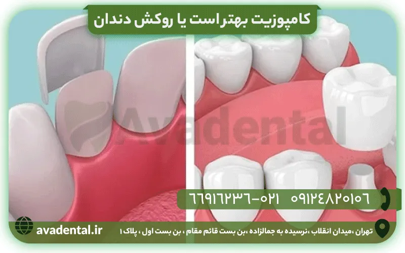 کامپوزیت بهتر است یا روکش دندان 2 کامپوزیت بهتر است یا روکش دندان
